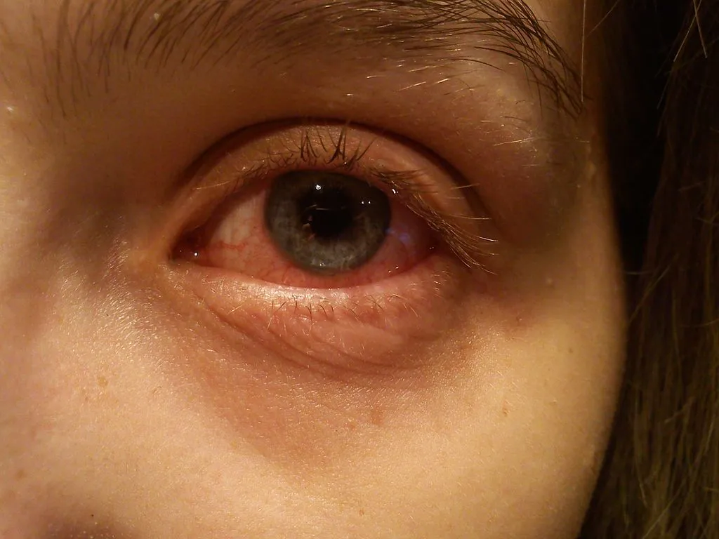 Pink Eye