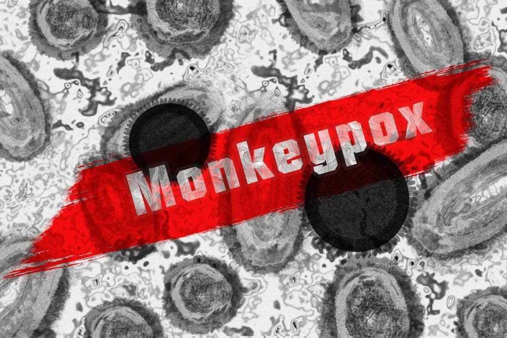 Monkeypox symptoms in kids