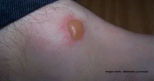 Read more about the article How to Treat a Popped Blister Without Skin: Expert Advice and Effective Remedies