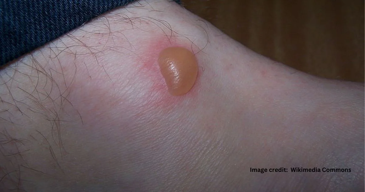 Treat a Popped Blister Without Skin